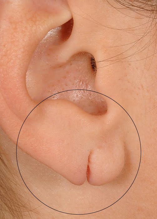 Earlobe Repair